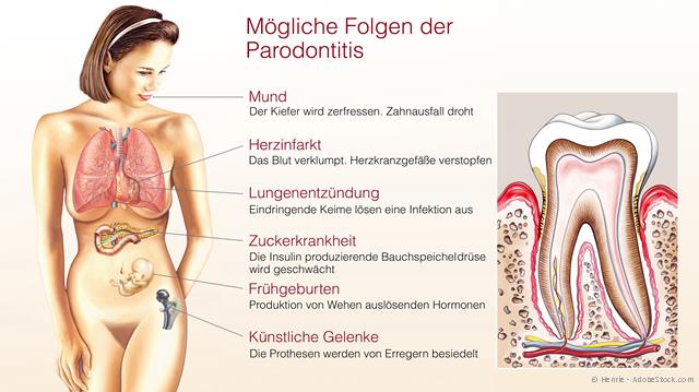 Eine Parodontitis kann sich auf den gesamten Organismus auswirken. Eine Parodontitis kann sich auf den gesamten Organismus auswirken.
