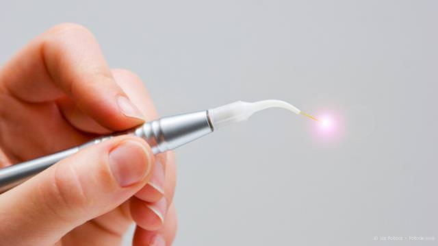 Dental-Laser: Unblutig und schmerzarm Dental-Laser: Unblutig und schmerzarm