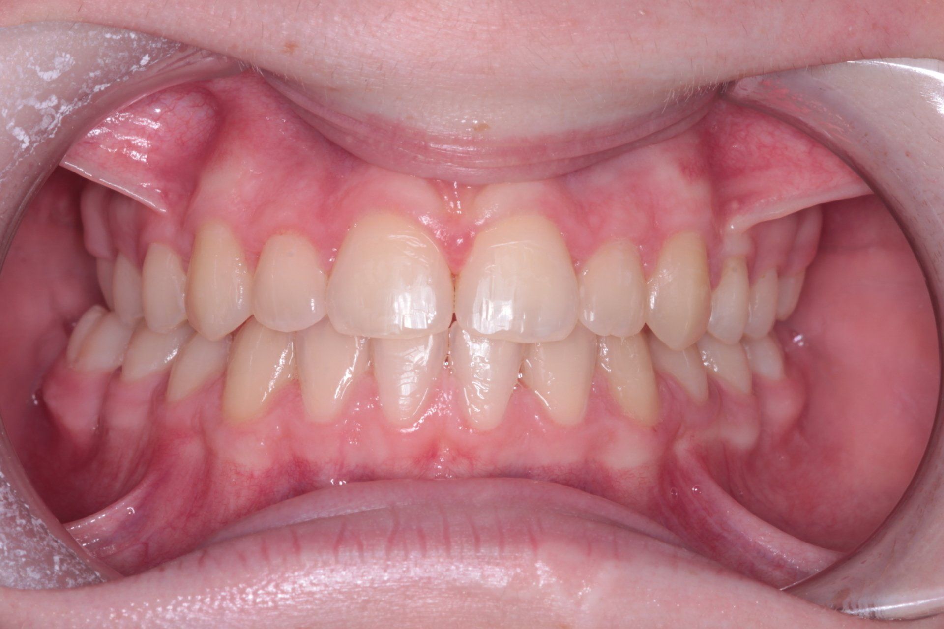 Teeth 2