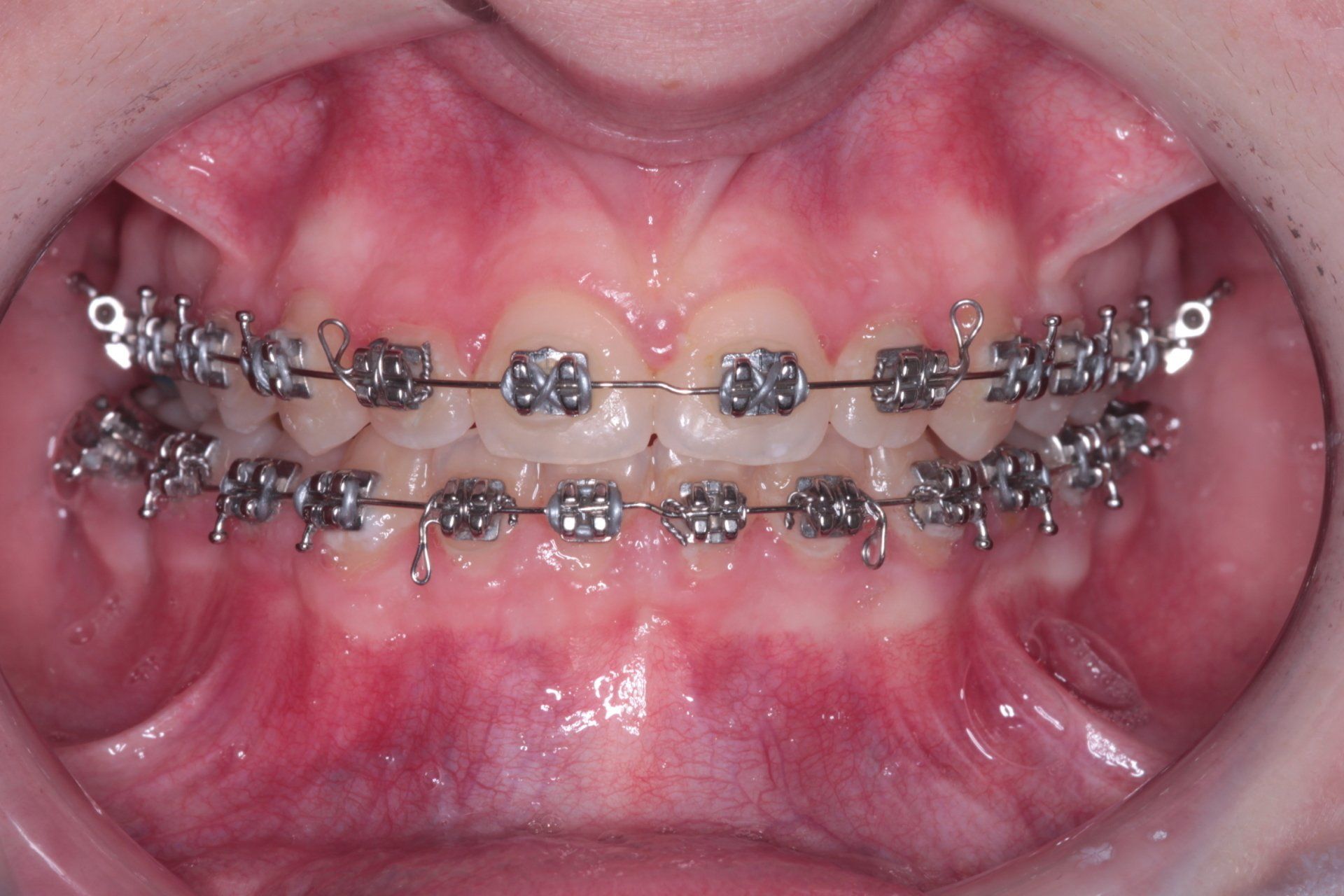 Amelia with braces