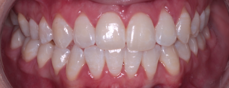 Teeth 2