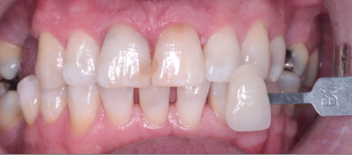 Teeth 4