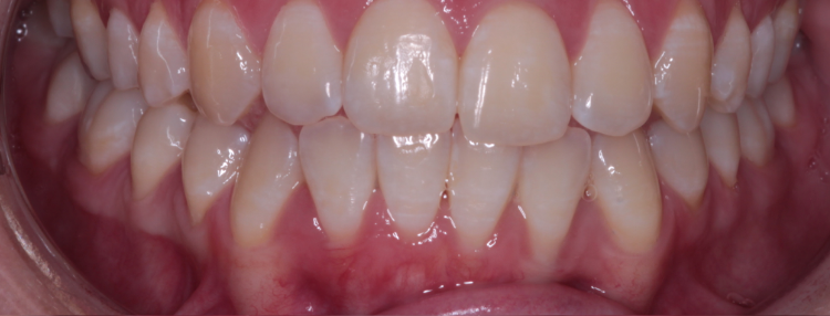 Teeth 1