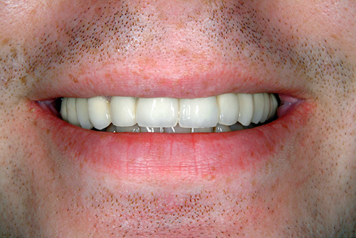 Photo after dental implant