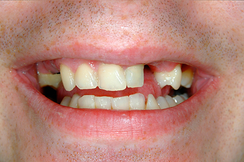 Photo before dental implant