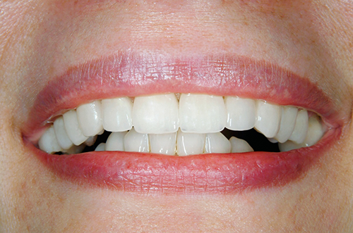 Photo after teeth whitening