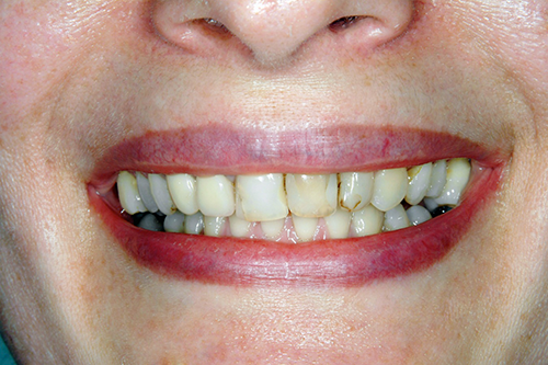 Photo before teeth whitening