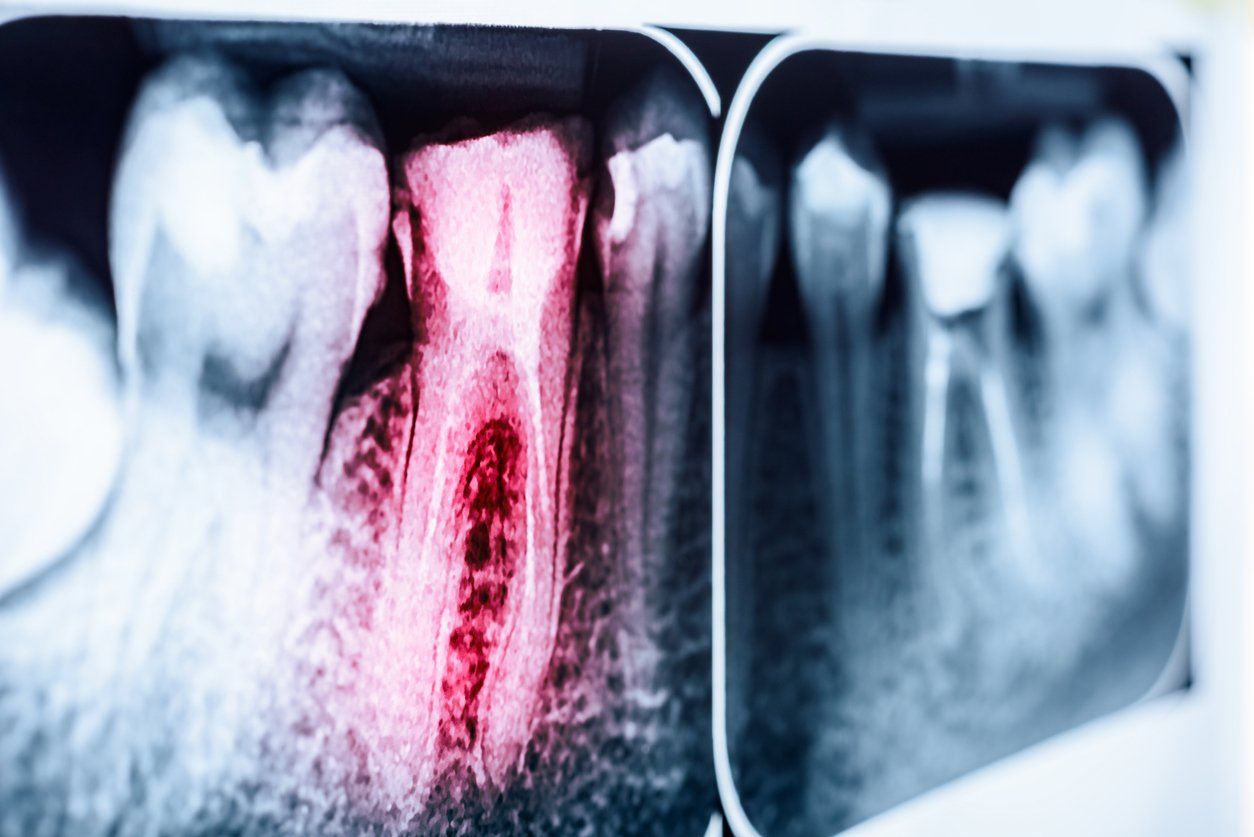 Endodontics (Root Canal Treatment)