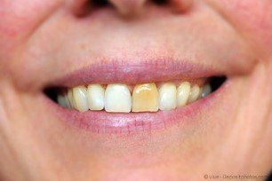 Auch einzelne Zähne können aufgehellt werden Auch einzelne Zähne können aufgehellt werden