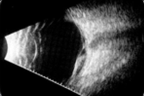 Radiografia occhio