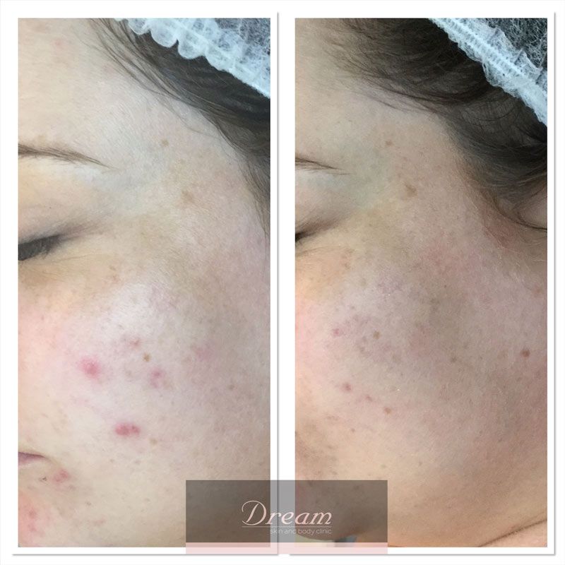acne being fixed