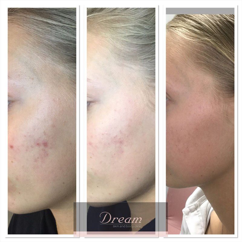 facial acne