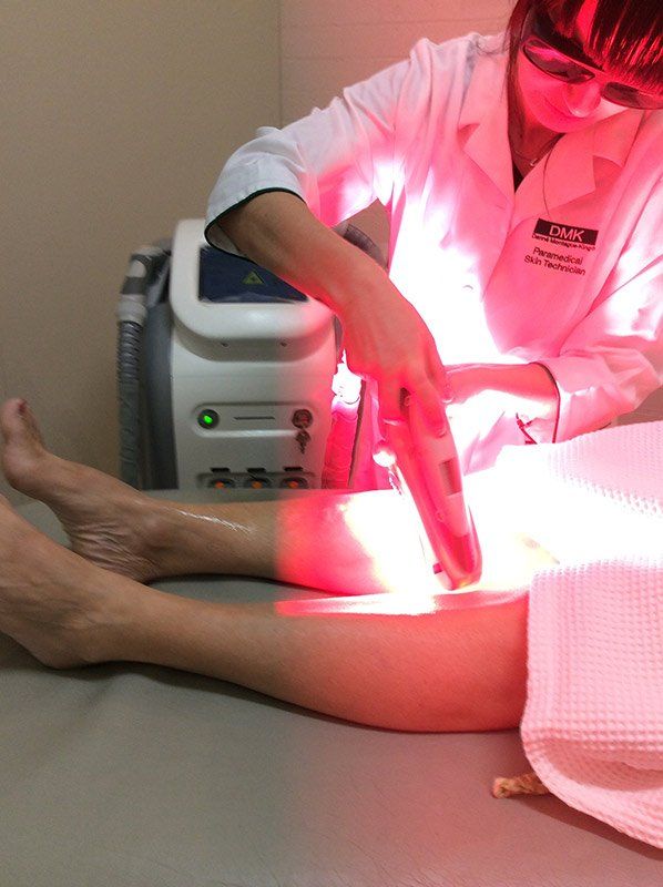 IPL intense pulsed light hair removal treatment