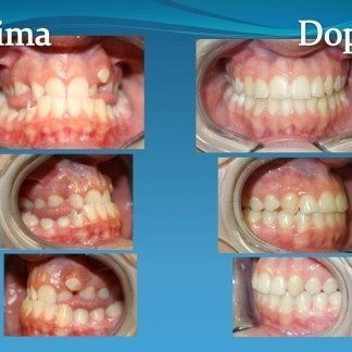 Denti prima e dopo intervento odontoiatrico