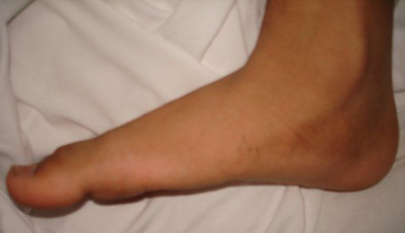 Cavovarus Feet