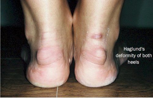 Haglund’s Deformity patient