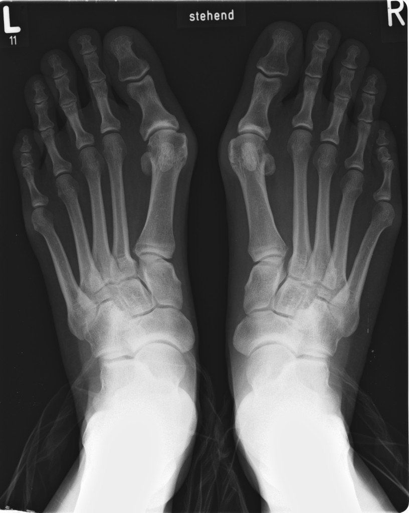 Hallux abducto valgus.
