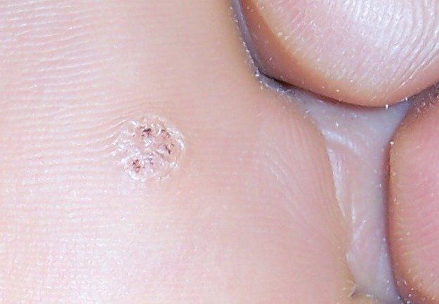 A plantar wart