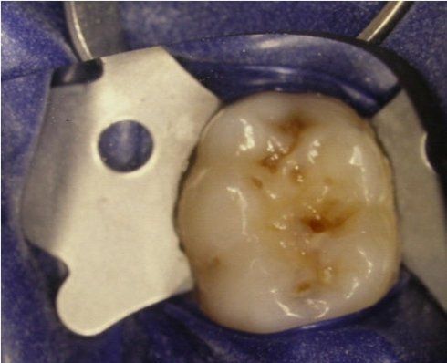 cura dei denti