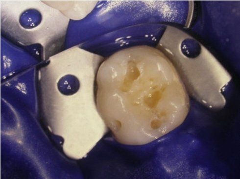 cura dei denti