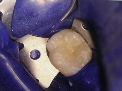 cura dei denti