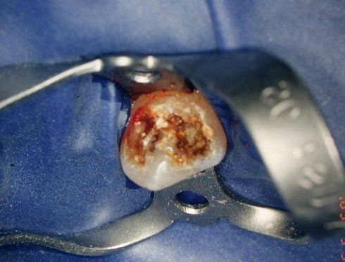 cura dei denti