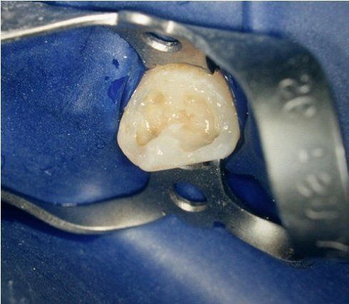 cura dei denti
