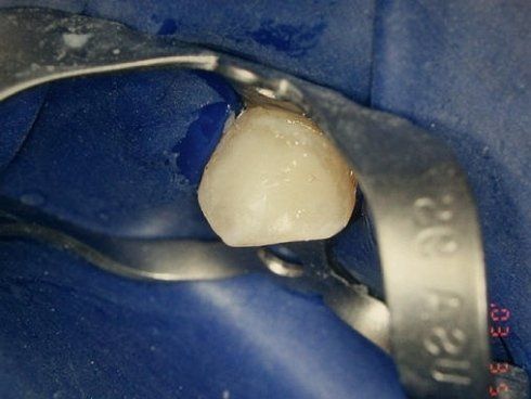 cura dei denti