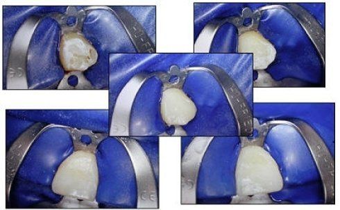cura dei denti