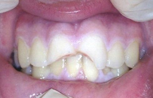 Denti rotti