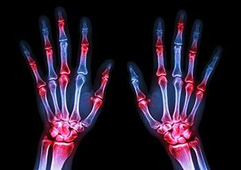 Arthritis at Multiple Joint of Hands — Arthritis Treatment in White Plains, New York Arthritis at Multiple Joint of Hands — Arthritis Treatment in White Plains, New York