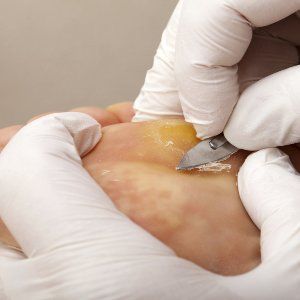 Standard footcare treatment