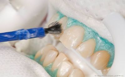 Auftragen des Bleaching-Gels beim Power-Bleaching. Das Zahnfleisch wurde vorab mit einem Schutz abgedeckt. Auftragen des Bleaching-Gels beim Power-Bleaching. Das Zahnfleisch wurde vorab mit einem Schutz abgedeckt.