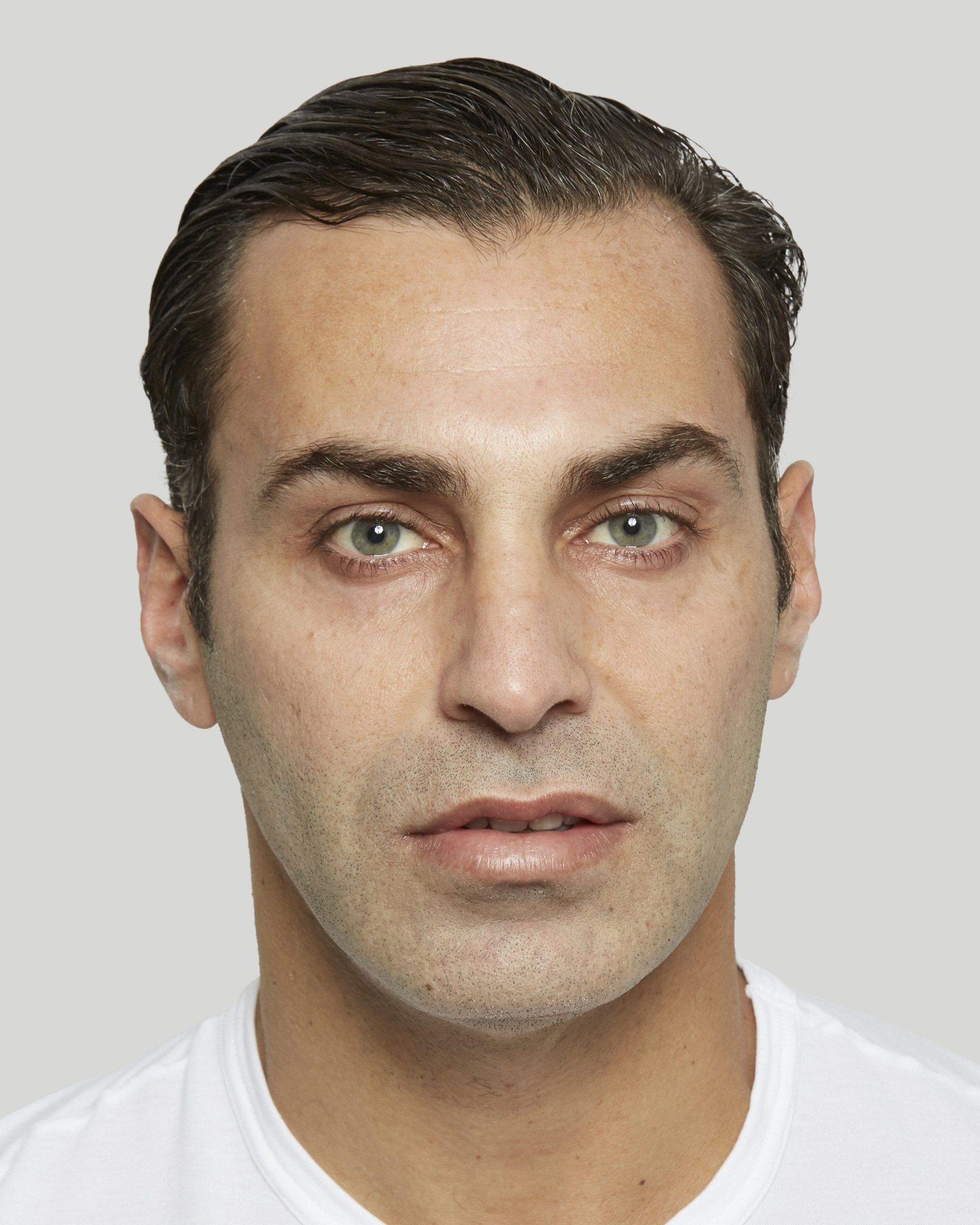 Sculptra® patient before and after photos