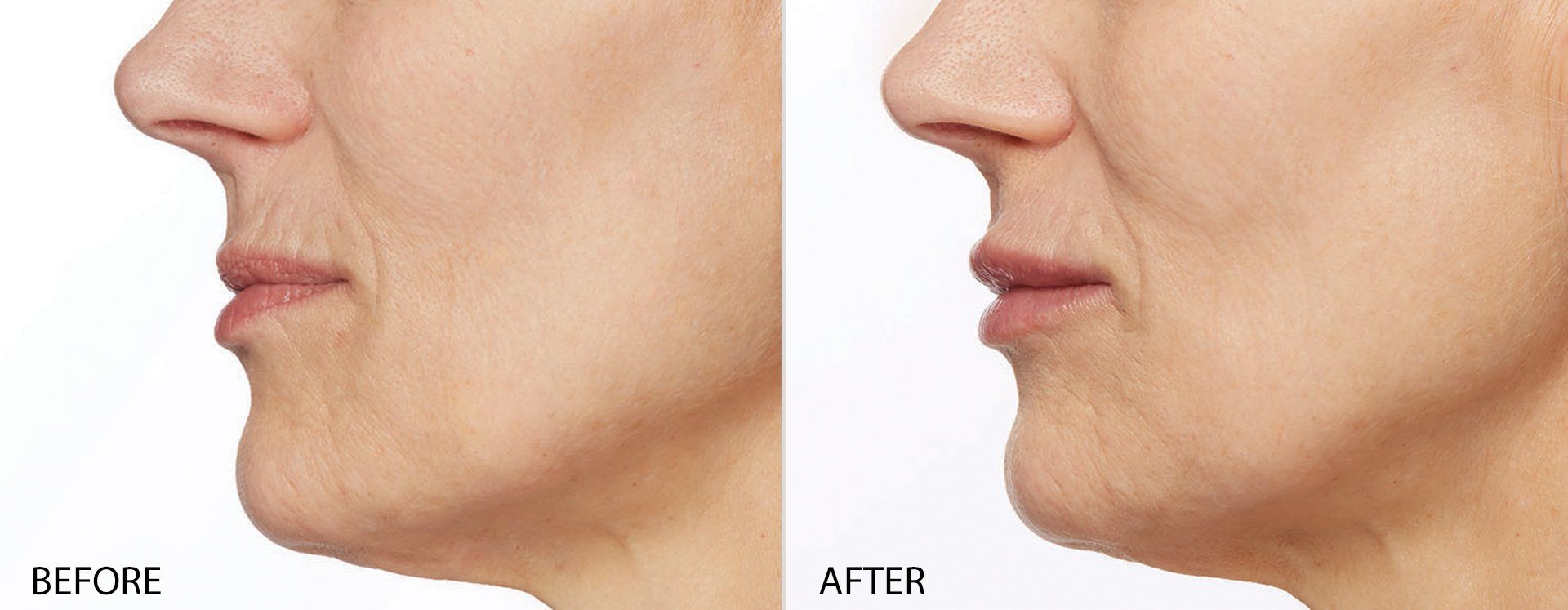 Restylane patient before and after