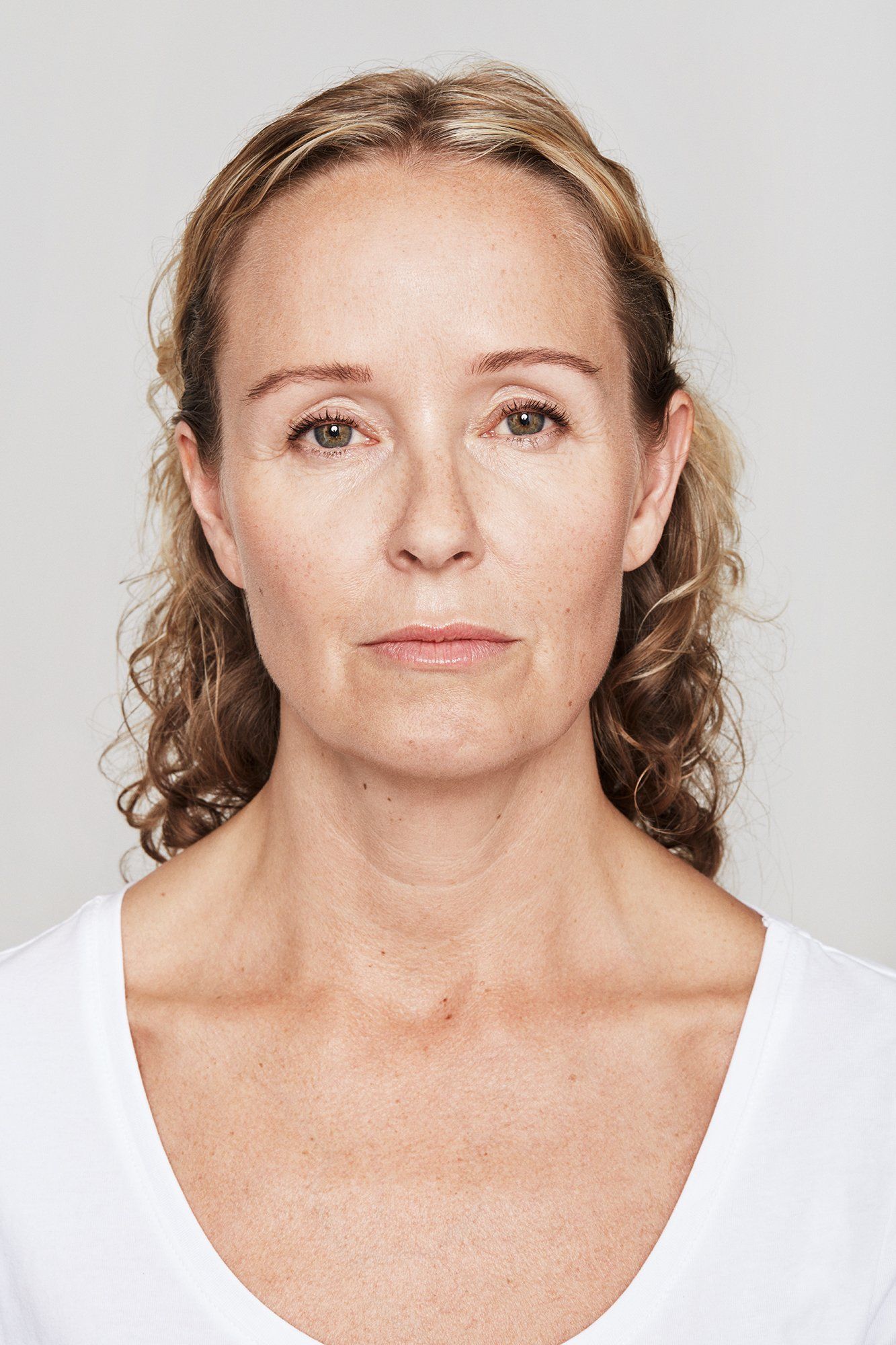 patient after Dysport treatment