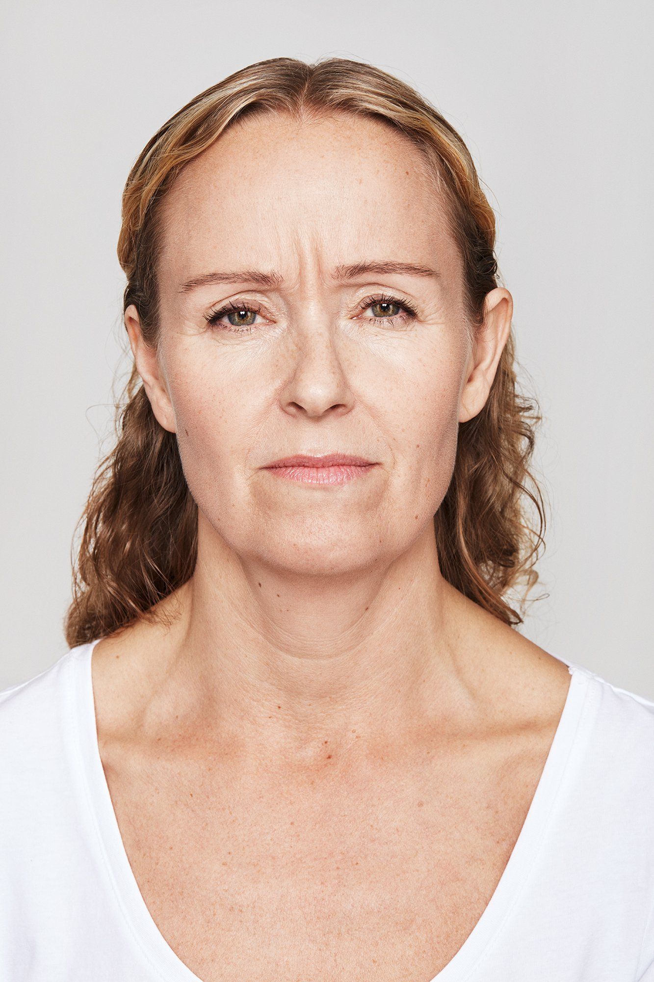 patient before Dysport treatment