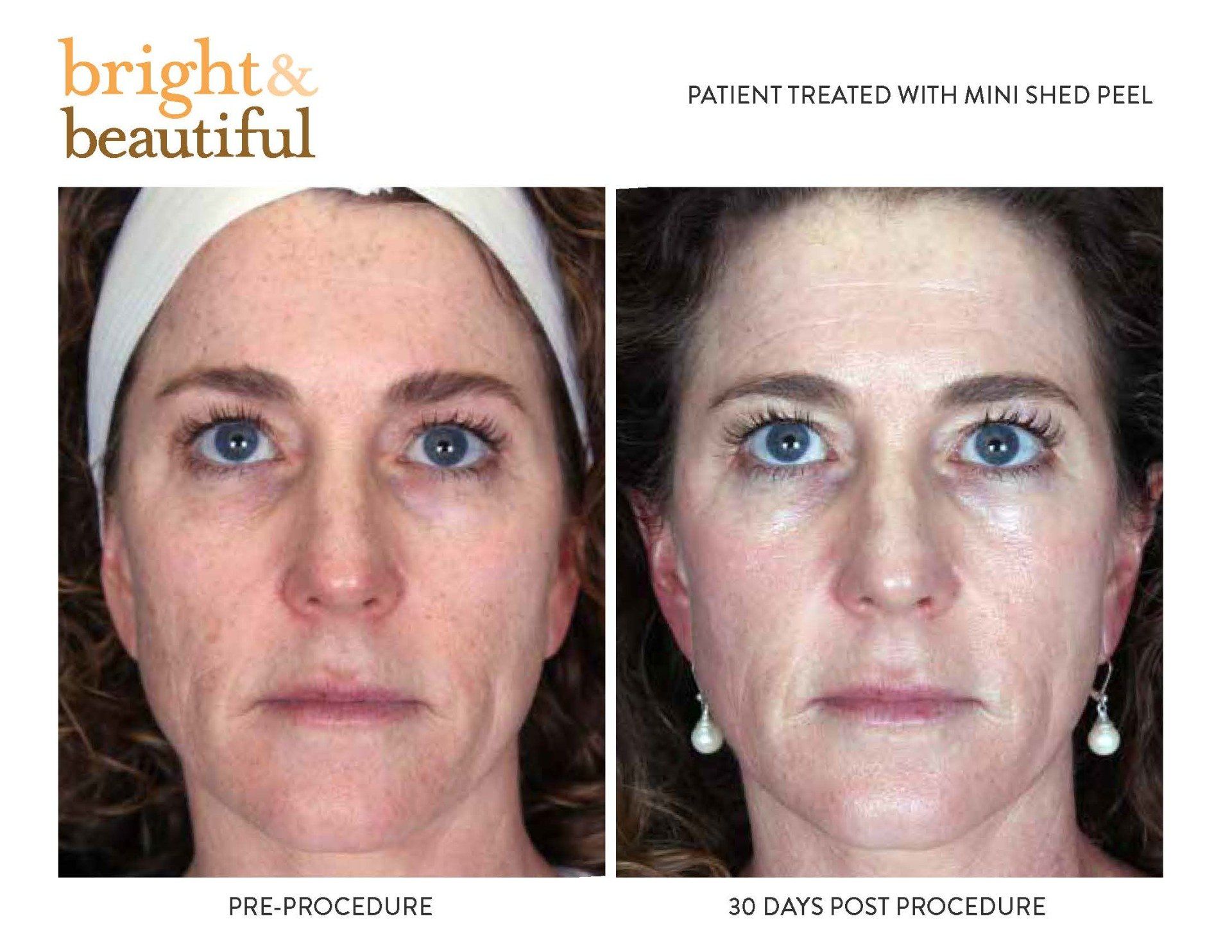 before and after photo of patient treated with Mini Shed peel