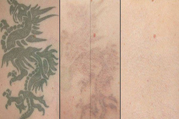 progression of laser tattoo removal
