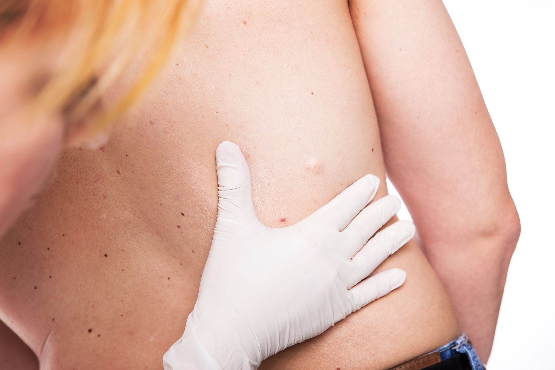 dermatologist examining cyst on man's back