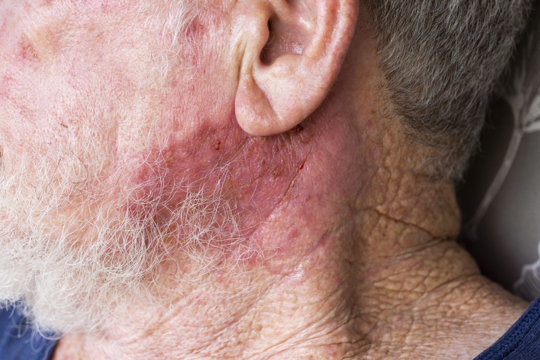 area of skin cancer under elderly man's ear