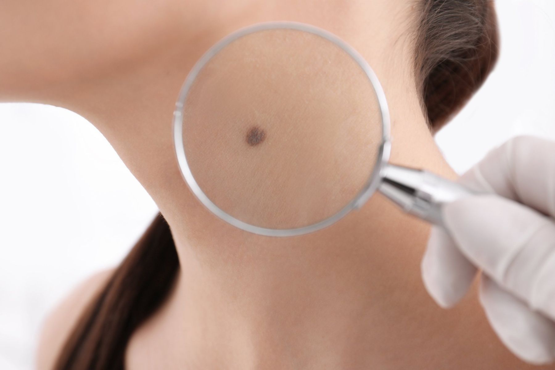 dermatologist magnifying mole on woman's neck