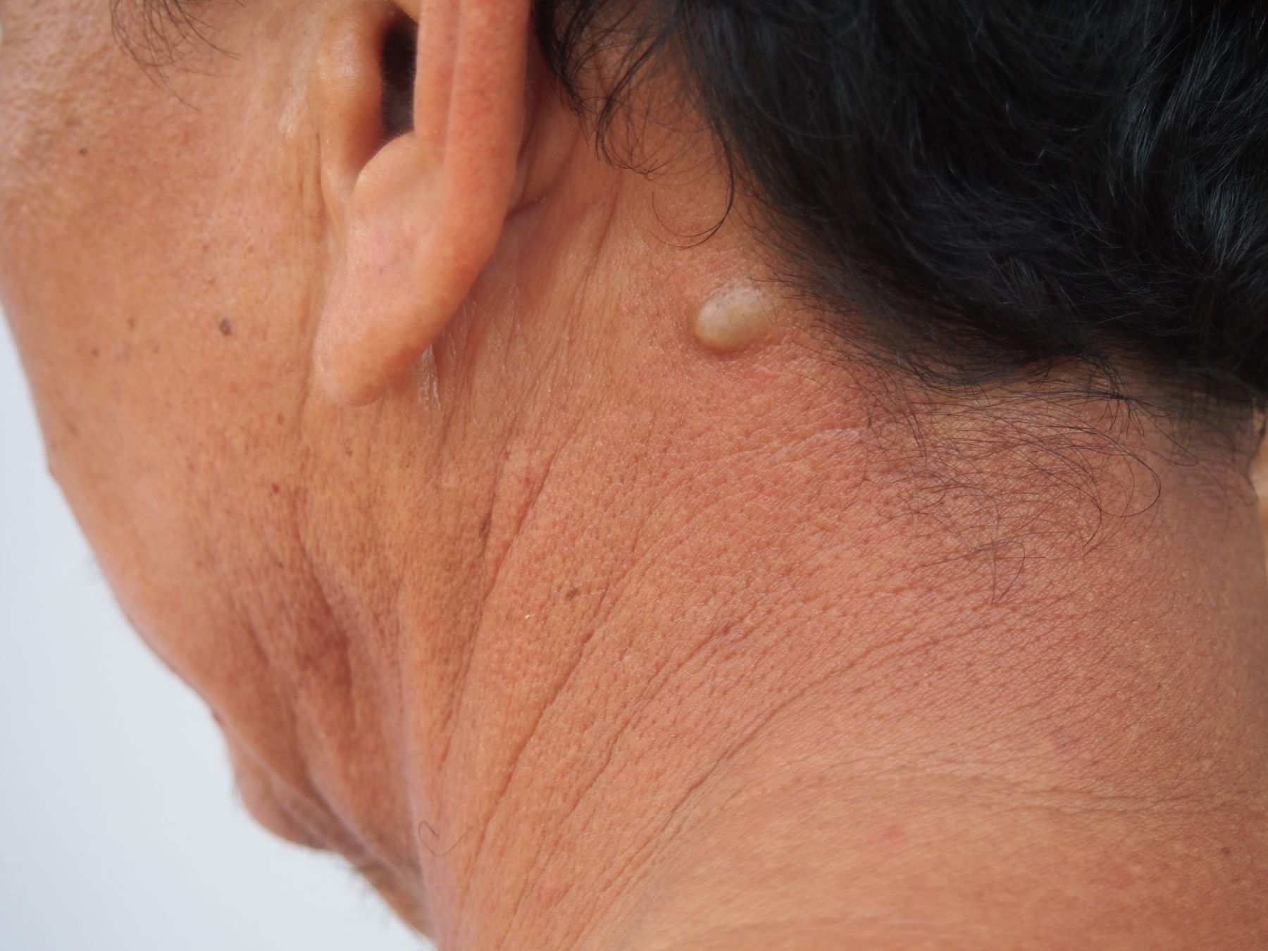 mature man with cyst behind ear