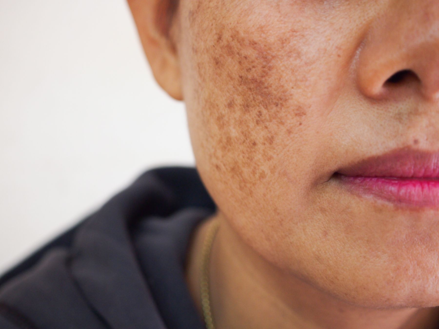 melasma pigmentation on female face