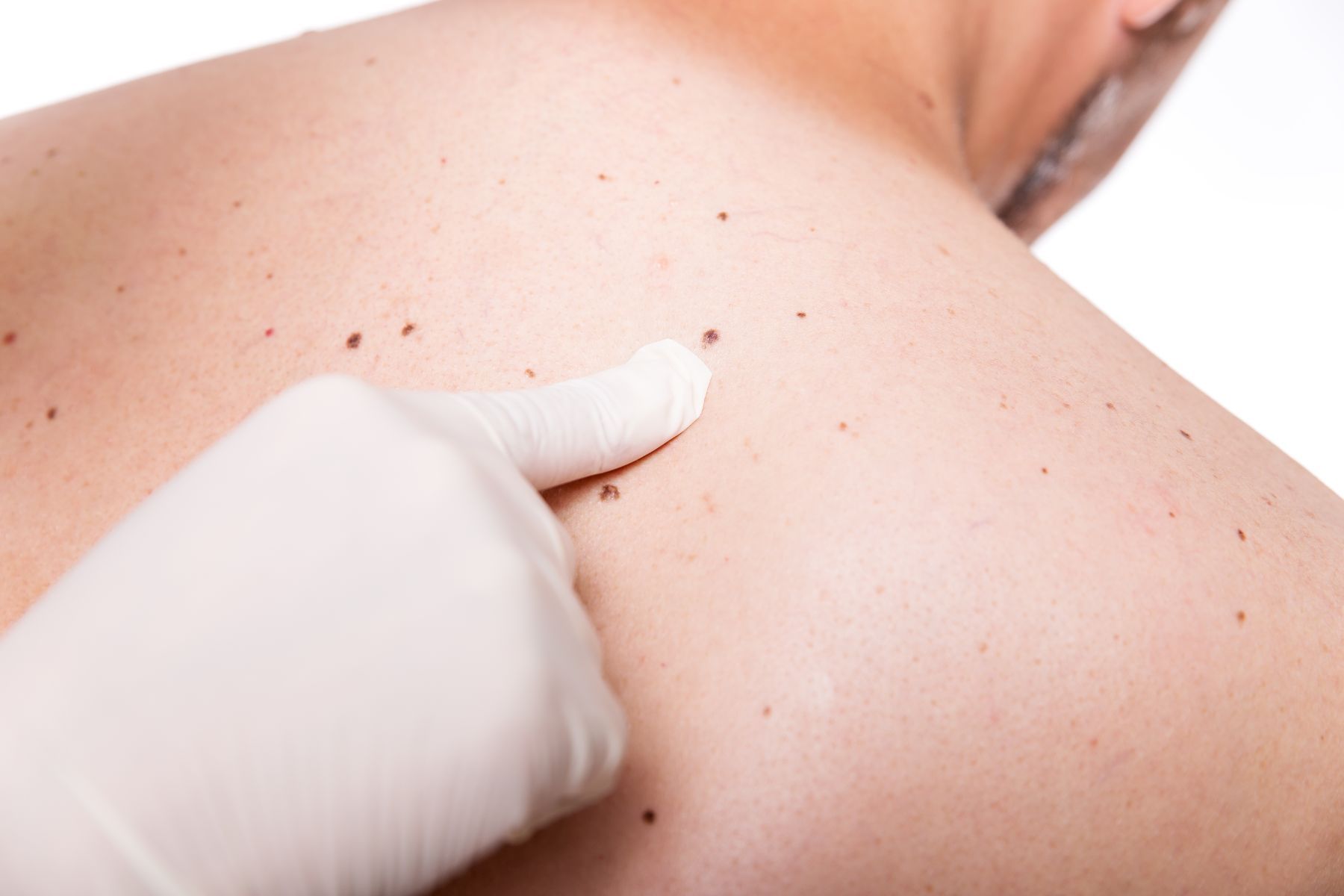 skin cancer screening of man's back