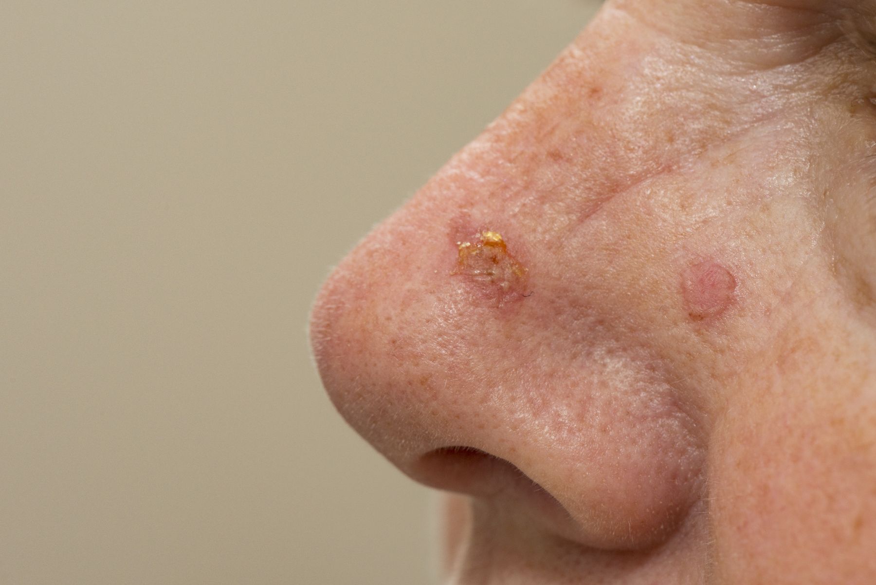 skin cancer lesions on a patient's nose