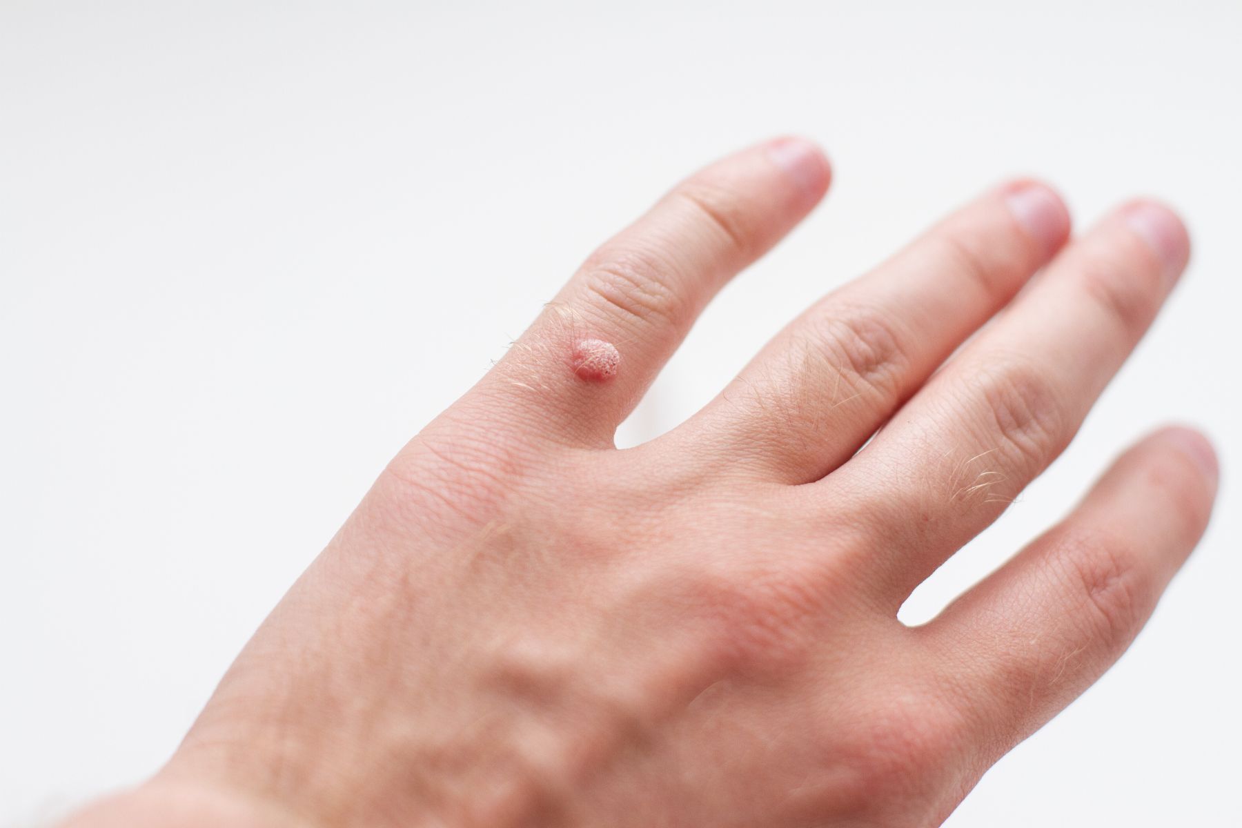 wart on pinky finger