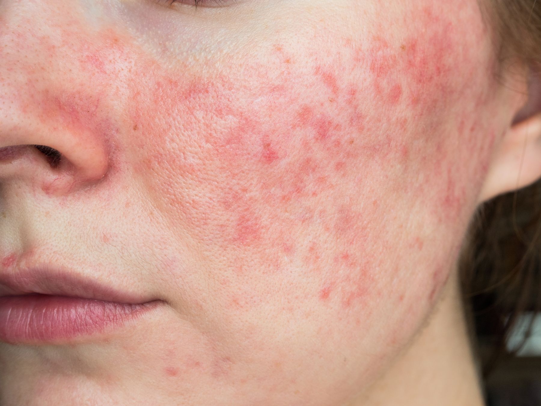 woman with rosacea on cheeks
