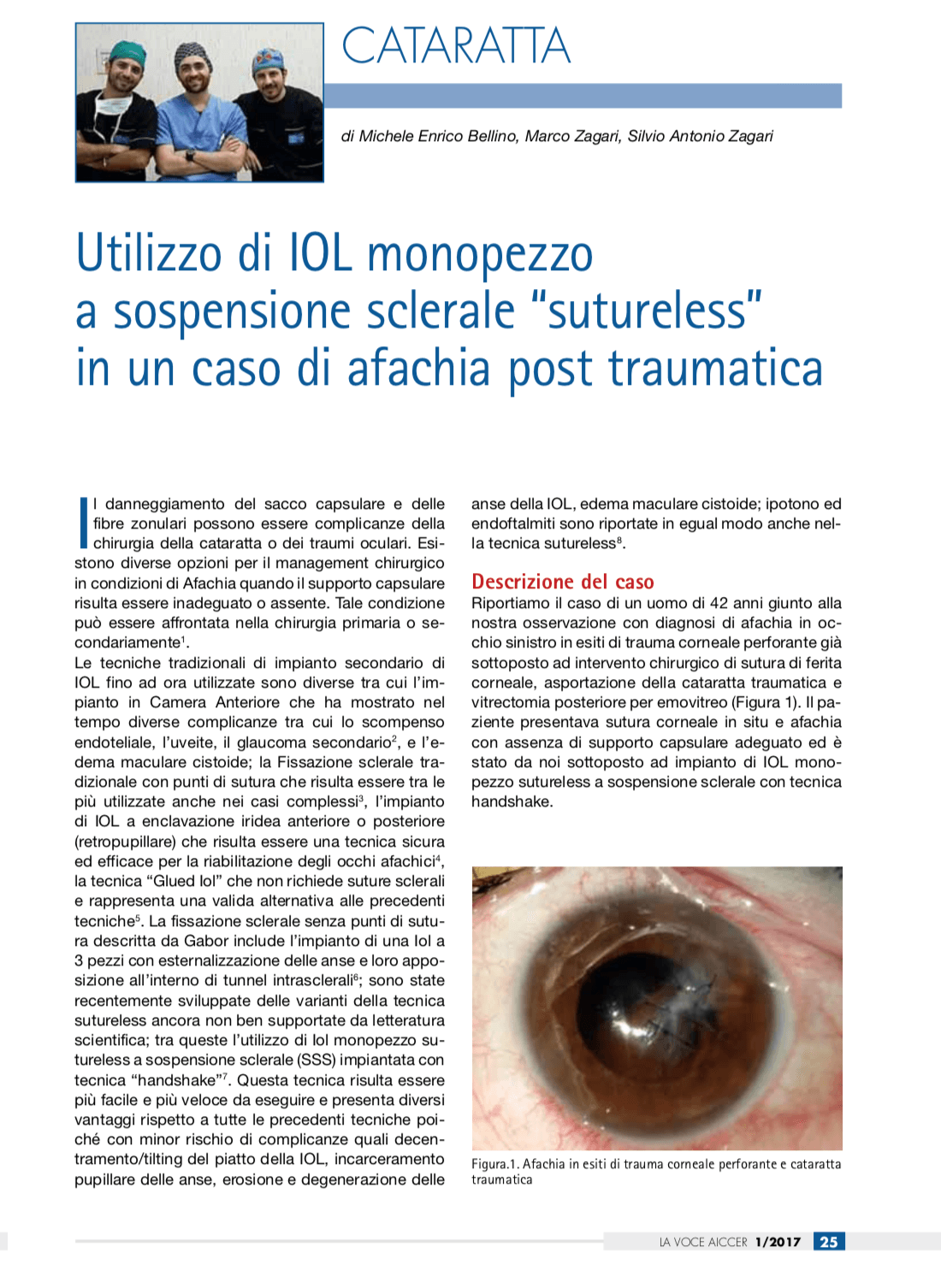Dott Bellino M - Utilizzo di IOL a sospensione sclerale suturless