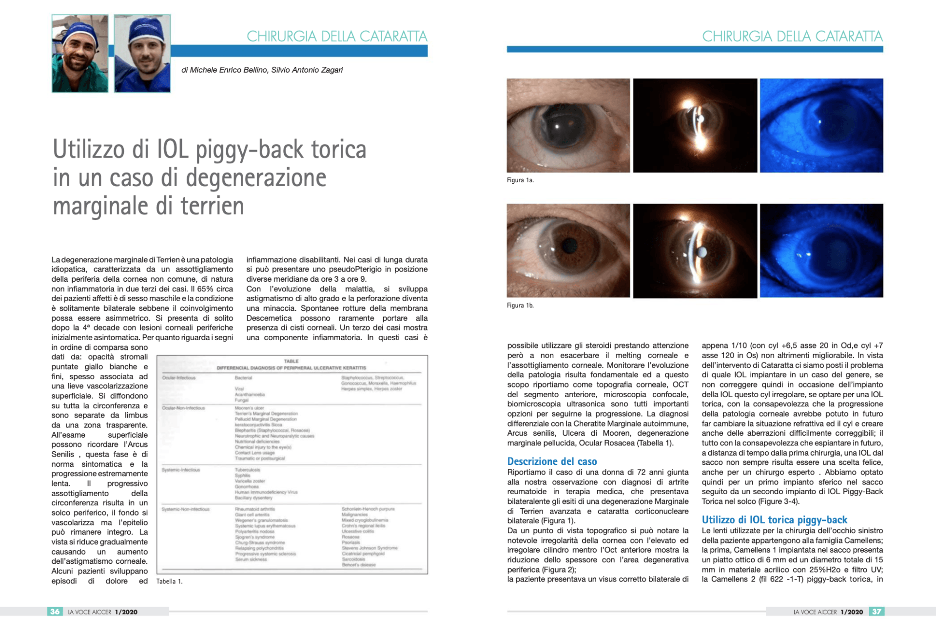 Dott Bellino Oculista - utilizzo di IOL PIGGY-BACK torica in un caso di Degenerazione Corneale di Terrien